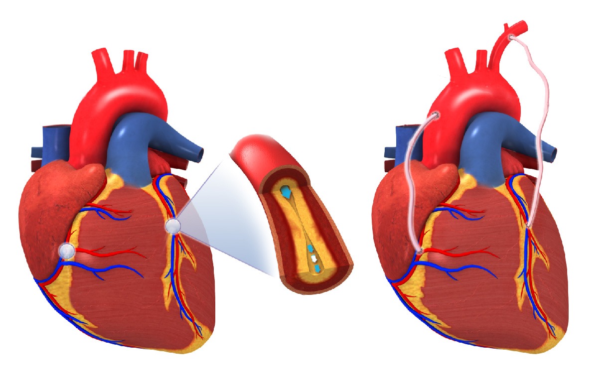 Cardiac Surgery 