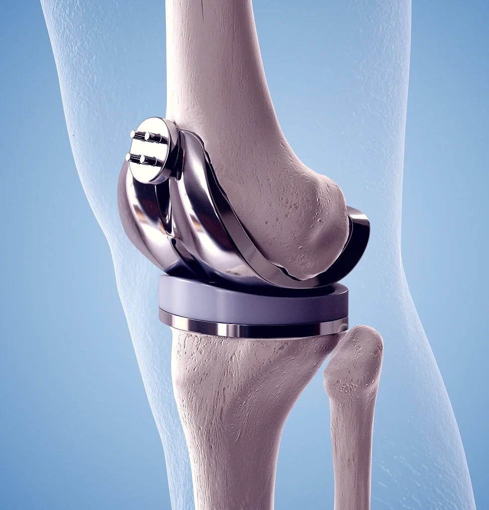 Total Knee Replacement (TKR)